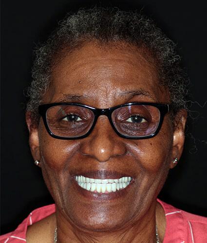 full face view of woman with new you dentures