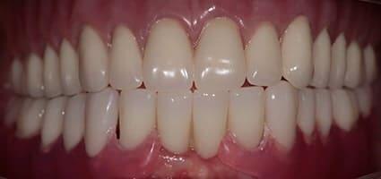 New You Dentures after