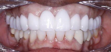 Dental Implant and Porcelain Veneers