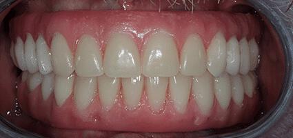 Implant Dentures