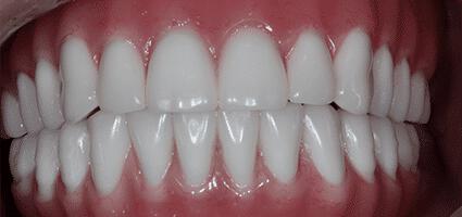 Implant Dentures