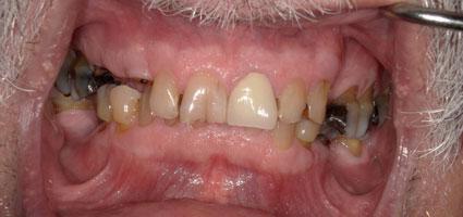 Porcelain Restorations