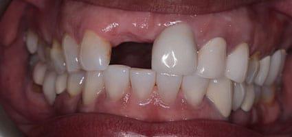 Dental Implant and Porcelain Veneers