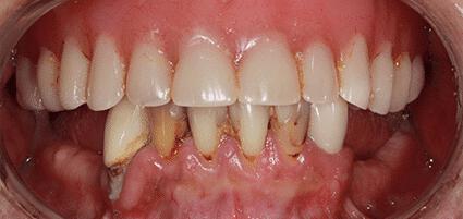 Implant Dentures